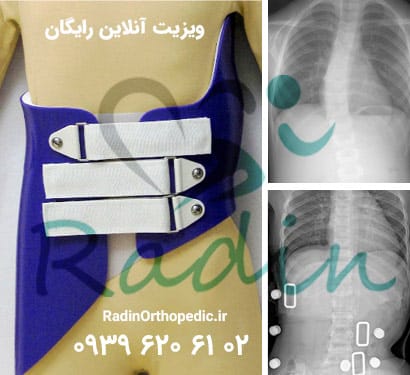 اسکولیوز و بریس بوستون