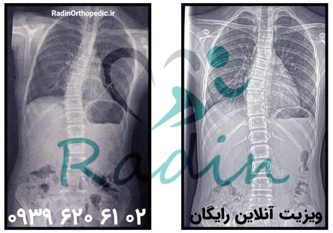 اسکولیوز یا انحراف ستون فقرات