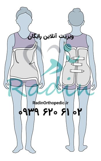 بریس بوستون برای درمان انحراف ستون فقرات