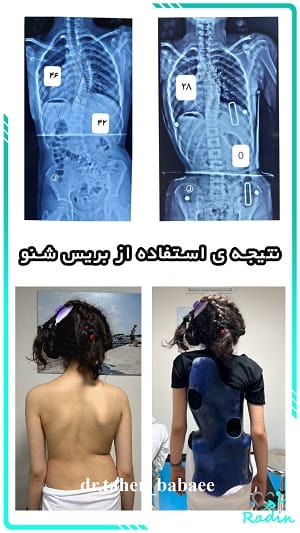 بریس شنو برای درمان اسکولیوز نوجوان ایرانی