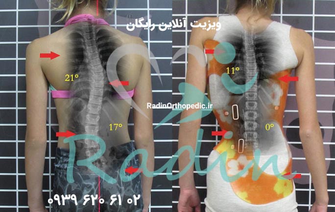 بهبود اسکولیوز