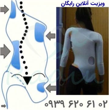 تاثیر گذاری بریش شنو بر ستون فقرات برای درمان اسکولیوز