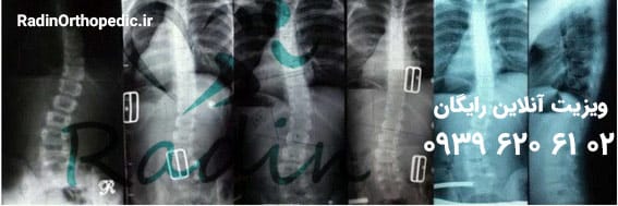 عکس رادیگرافی ستون فقرات و روش درمان با بریس شنو
