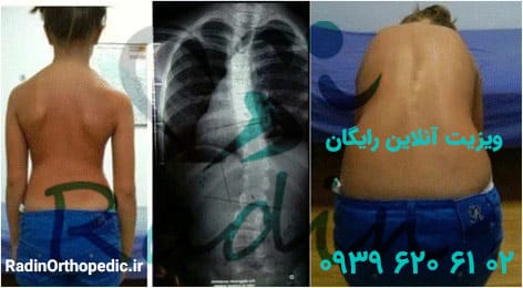 مشکل اسکولیوز در نوجوانان