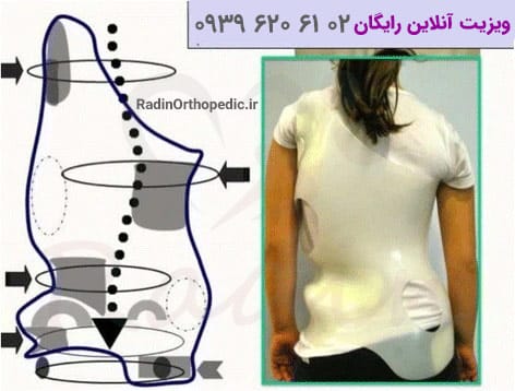 نحوه تاثیر گذاری بریس شنو برای درمان اسکولیوز
