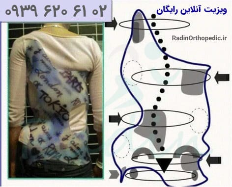 نمایش نقاط فشار بریس شنو برای درمان اسکولیوز
