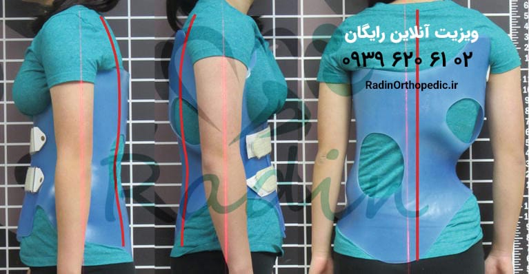 نمونه پوشیده شده بریس شنو برای درمان اسکولیوز