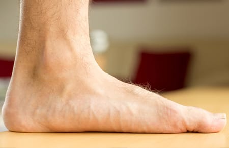 مشکل کف پای صاف