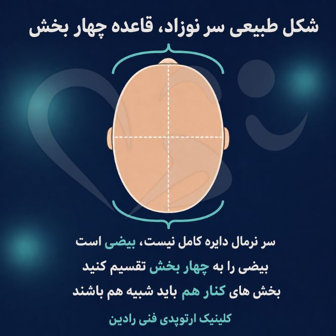 قاعده چهار بخش برای بررسی شکل طبیعی سر نوزاد از نمای بالا