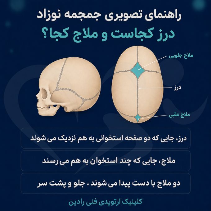 نقشه جمجمه نوزاد از نمای بالا با محل درزها و دو ملاج جلویی و عقبی