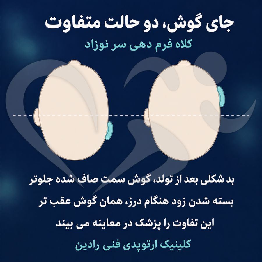 تفاوت جای گوش در بد شکلی بعد از تولد و بسته شدن زود هنگام درز جمجمه