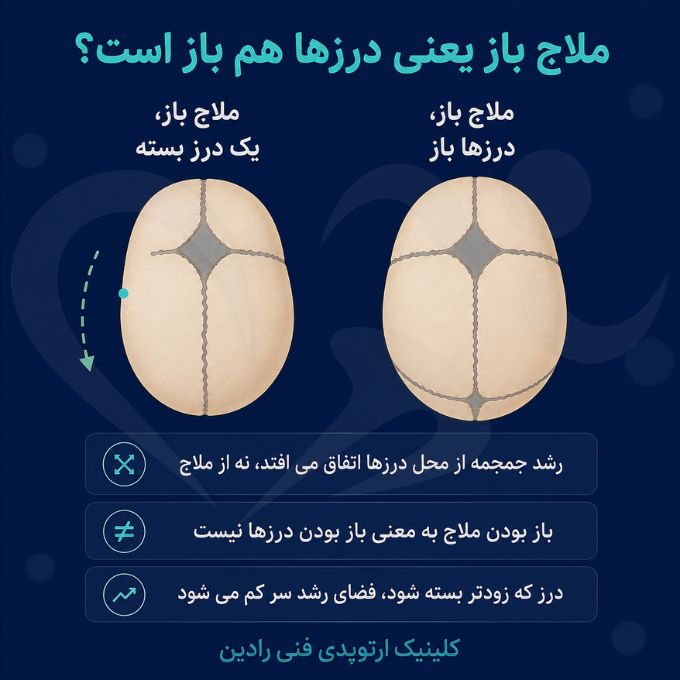 مقایسه دو جمجمه نوزاد با ملاج باز که در یکی از آنها یک درز زودتر بسته شده است