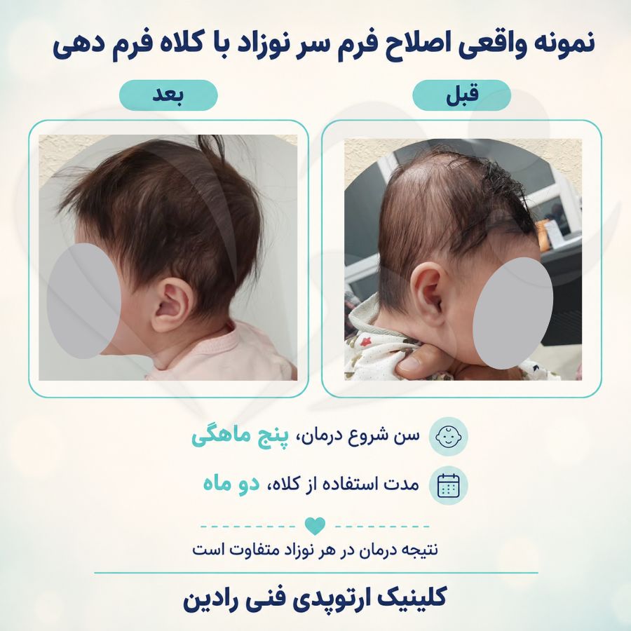 قبل و بعد کلاه فرم دهی سر نوزاد پنج ماهه با صافی شدید پشت سر پس از دو ماه