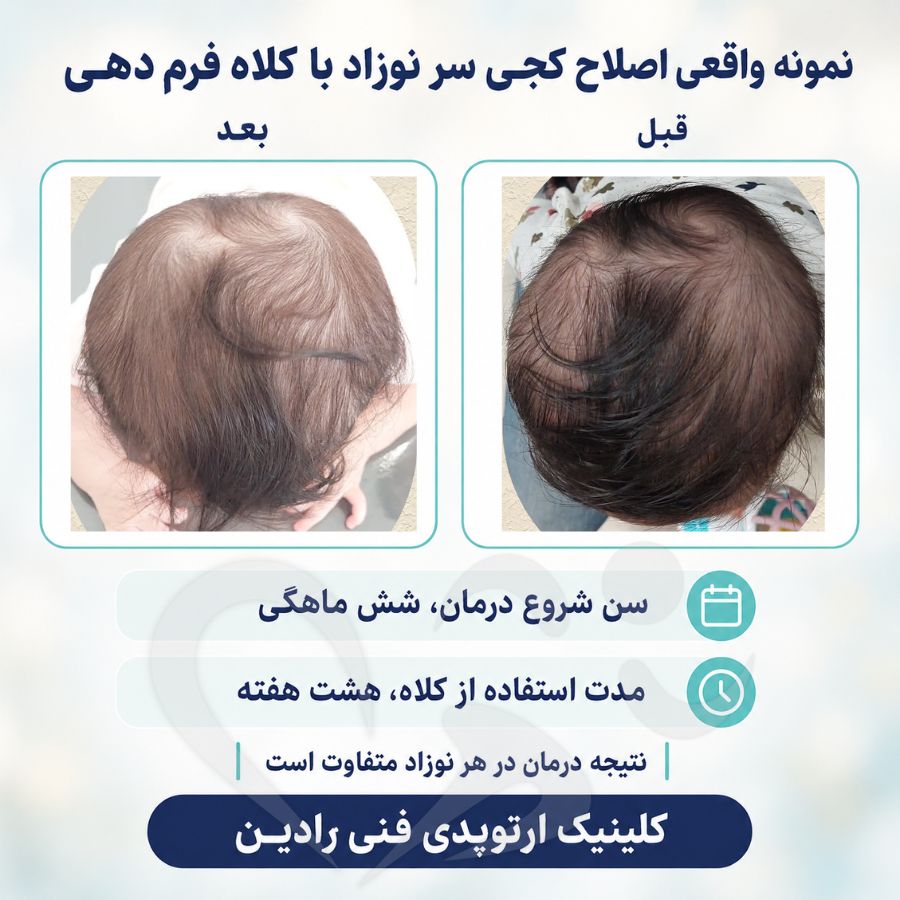 قبل و بعد کلاه فرم دهی سر نوزاد شش ماهه با کجی سر پس از هشت هفته استفاده